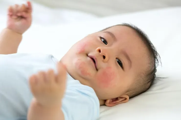penyakit kulit pada bayi
