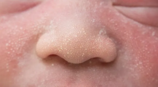 penyakit kulit pada bayi