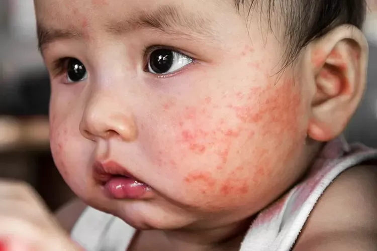 penyakit kulit pada bayi