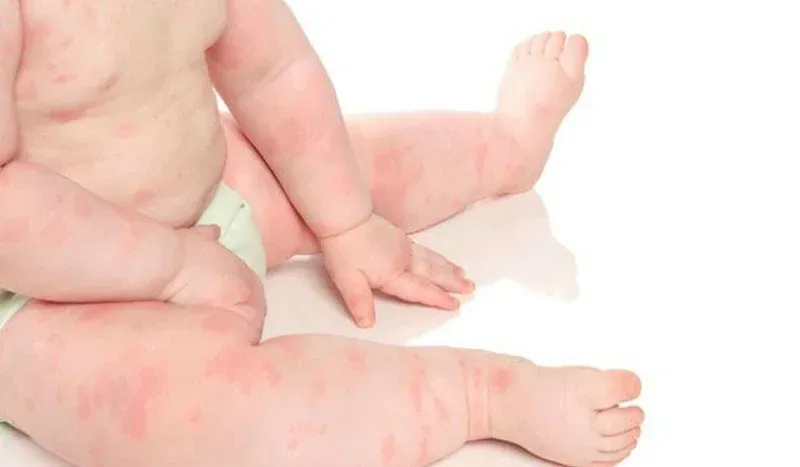 penyakit kulit pada bayi