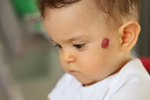 penyakit kulit pada bayi