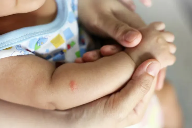 cara menghilangkan bekas gigitan nyamuk pada bayi