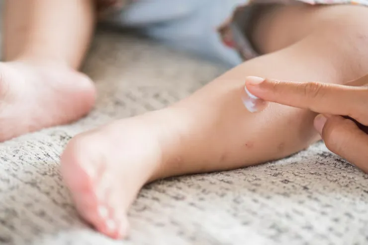 cara menghilangkan bekas gigitan nyamuk pada bayi