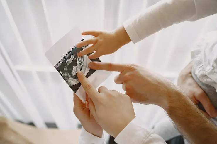 kelebihan bayi sungsang