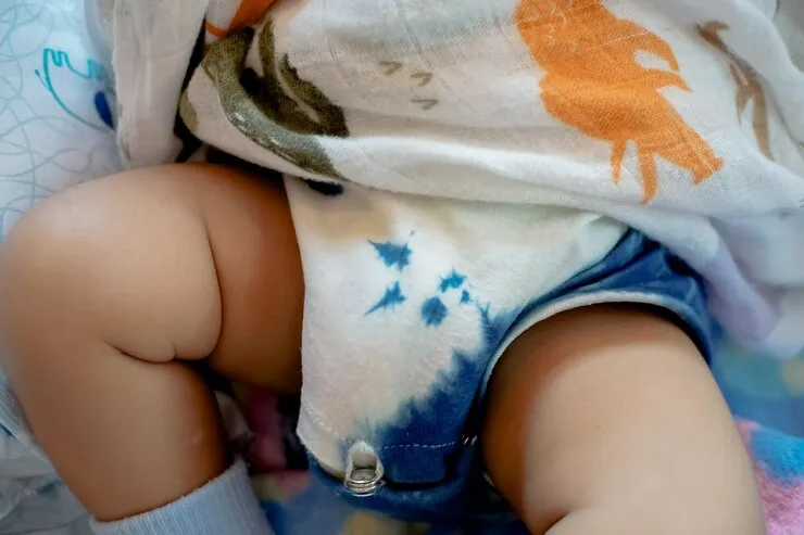 jenis ruam popok pada bayi
